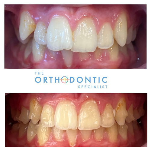 Adult Invisalign impacted canines in Amersham