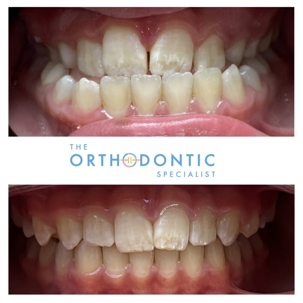 palatal expansion for children